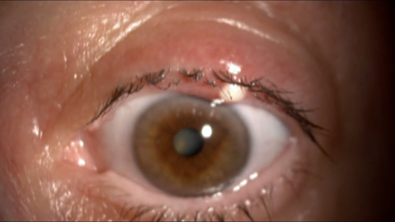 Descubre por qué sale orzuela en el ojo: causas sorprendentes reveladas
