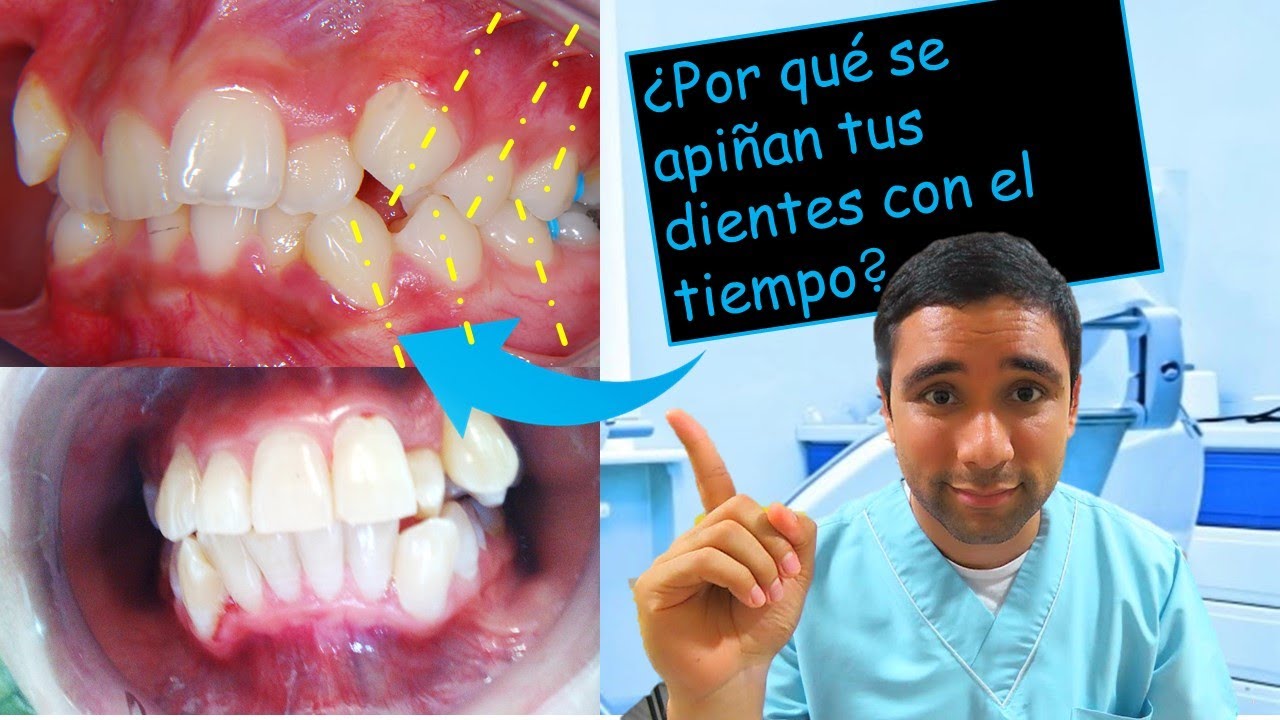 Descubre por qué los dientes se tuercen en adultos