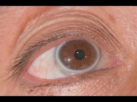 Descubre la causa de la mancha blanquecina en el ojo y cómo solucionarla