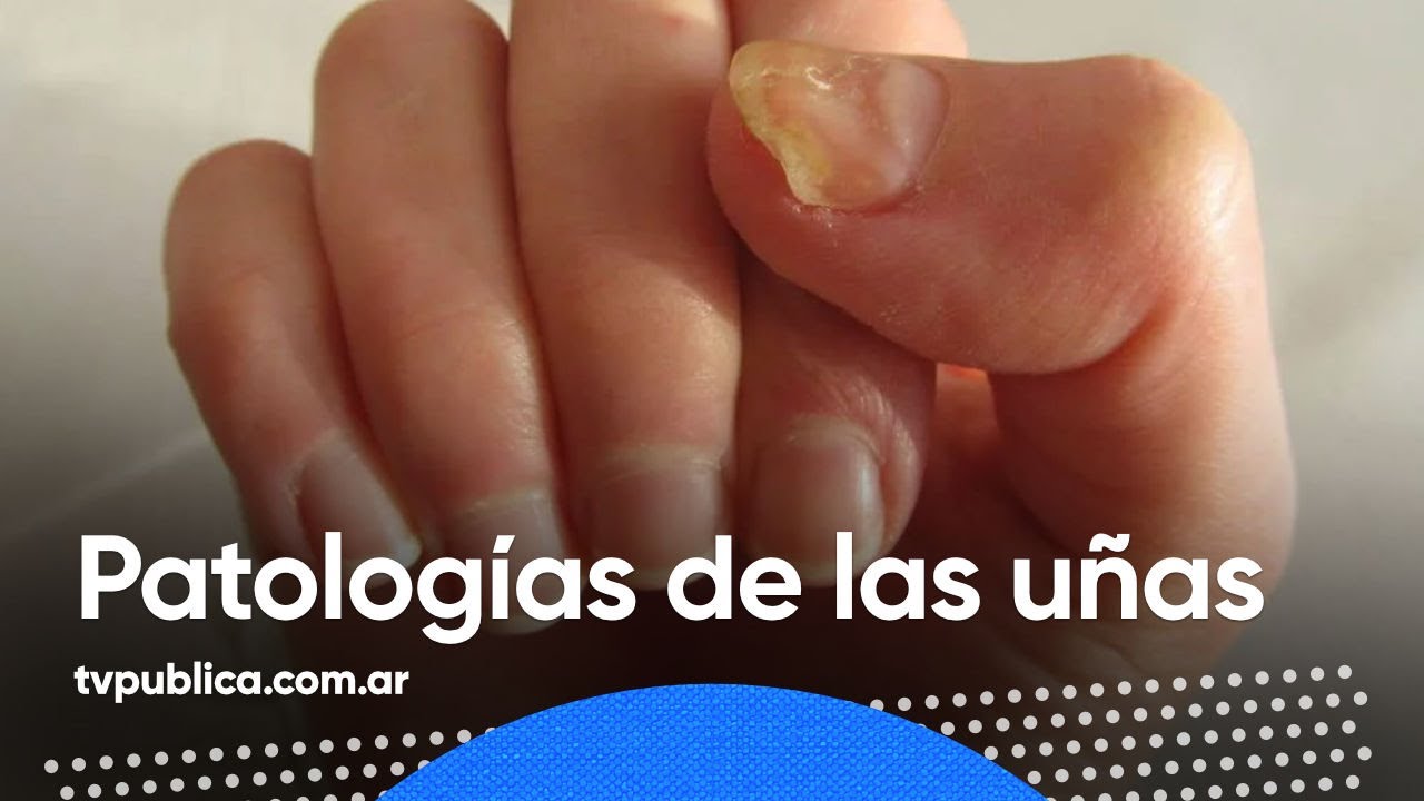 Descubre las impactantes imágenes de enfermedades de las uñas que debes conocer